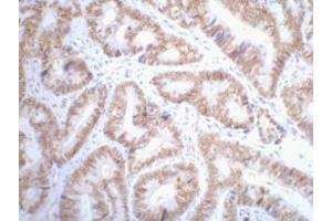 Immunohistochemistry (IHC) staining of Human colon cancer tissue paraffin-embedded, diluted at 1:200. (p53 antibody)