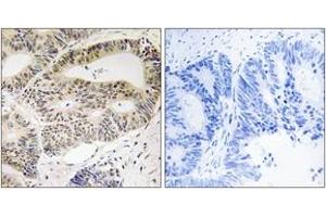 Immunohistochemistry analysis of paraffin-embedded human colon carcinoma tissue, using OSR1 (Ab-185) Antibody. (OSR1 antibody  (AA 151-200))