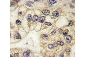 CD14 antibody used to stain FFPE human lung carcinoma (CD14 antibody  (AA 292-322))