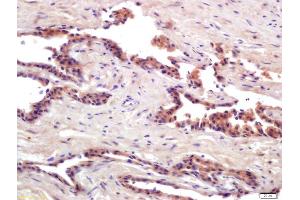 Formalin-fixed and paraffin embedded human prostate cancer labeled with Anti-PRSS8 Polyclonal Antibody, Unconjugated (ABIN761891) at 1:200 followed by conjugation to the secondary antibody and DAB staining (PRSS8 antibody  (AA 65-165))