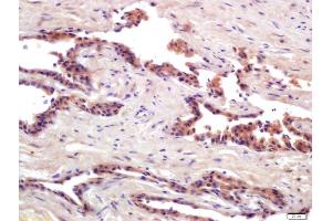 Formalin-fixed and paraffin embedded human prostate cancer labeled with Anti-PRSS8 Polyclonal Antibody, Unconjugated (ABIN761891) at 1:200 followed by conjugation to the secondary antibody and DAB staining