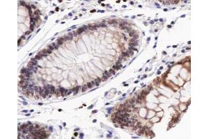 ABIN6266458 at 1/200 staining human colon carcinoma tissue sections by IHC-P. (MUC1 antibody  (pTyr1229))