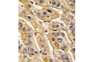 Formalin-fixed and paraffin-embedded human hepatocarcinoma tissue reacted with HIBCH antibody (Center), which was peroxidase-conjugated to the secondary antibody, followed by DAB staining. (HIBCH antibody  (Middle Region))