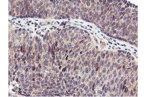 Immunohistochemical staining of paraffin-embedded Carcinoma of Human bladder tissue using anti-RFXANK mouse monoclonal antibody. (RFXANK antibody)