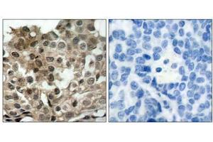Immunohistochemical analysis of paraffin-embedded human breast carcinoma tissue using FKHRL1 (Ab-253) antibody (E021171). (FOXO3 antibody)