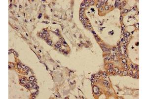 Immunohistochemistry of paraffin-embedded human pancreatic cancer using ABIN7145363 at dilution of 1:100 (GCNT3 antibody  (AA 250-419))