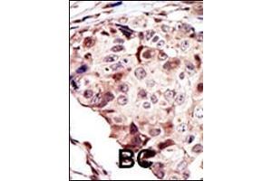 Formalin-fixed and paraffin-embedded human cancer tissue reacted with the primary antibody, which was peroxidase-conjugated to the secondary antibody, followed by AEC staining. (RYK antibody  (AA 160-190))