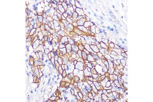Immunohistochemistry of paraffin-embedded human esophageal cancer using NDRG1 Rabbit mAb (ABIN7268783) at dilution of 1:100 (40x lens). (NDRG1 antibody)