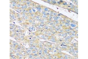 Immunohistochemistry of paraffin-embedded Human liver cancer using ARL4A Polyclonal Antibody at dilution of 1:100 (40x lens). (ARL4A antibody)