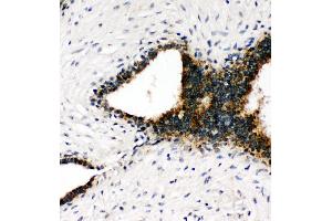 Anti-Annexin VIII antibody, IHC(P) IHC(P): Human Mammary Cancer Tissue (Annexin VII antibody  (C-Term))