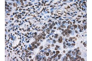 Immunohistochemical staining of paraffin-embedded liver tissue using anti-ATP5Bmouse monoclonal antibody. (ATP5B antibody)