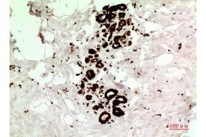 Immunohistochemistry (IHC) analysis of paraffin-embedded Human Breast Cancer, antibody was diluted at 1:100. (HSP70 antibody  (Ser102))
