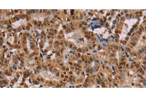 Immunohistochemistry of paraffin-embedded Human thyroid cancer using hnRNP G Polyclonal Antibody at dilution of 1:45 (RBMX antibody)