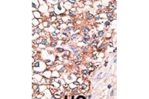 Formalin-fixed and paraffin-embedded human cancer tissue reacted with the primary antibody, which was peroxidase-conjugated to the secondary antibody, followed by AEC staining.