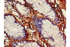 Immunohistochemistry of paraffin-embedded human gastric cancer using ABIN7175368 at dilution of 1:100 (VEGFB antibody  (AA 22-207))