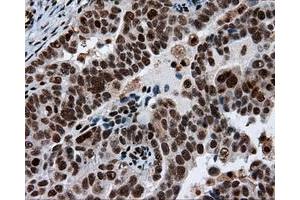 Immunohistochemical staining of paraffin-embedded Adenocarcinoma of breast tissue using anti-ACLY mouse monoclonal antibody.