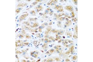Immunohistochemistry of paraffin-embedded human liver cancer using KIAA1456 antibody (ABIN5974326) at dilution of 1/200 (40x lens). (KIAA1456 antibody)
