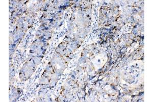 IHC testing of FFPE human lung cancer tissue with Bax antibody at 1ug/ml. (BAX antibody  (AA 17-48))
