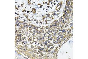 Immunohistochemistry of paraffin-embedded human skin carcinoma using ICOSL Antibody (ABIN6130065, ABIN6142131, ABIN6142132 and ABIN6222879) at dilution of 1:100 (40x lens). (ICOSLG antibody  (AA 19-256))