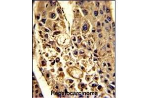 Formalin-fixed and paraffin-embedded human hepatocarcinoma with CFHL1 Antibody (C-term), which was peroxidase-conjugated to the secondary antibody, followed by DAB staining. (CFHR1 antibody  (C-Term))