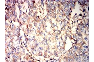 Immunohistochemical analysis of paraffin-embedded bladder cancer tissues using ALB mouse mAb with DAB staining. (Albumin antibody  (AA 410-609))