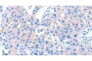 Immunohistochemistry of paraffin-embedded Human lung cancer tissue using NUAK1 Polyclonal Antibody at dilution 1:60