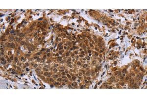 Immunohistochemistry of paraffin-embedded Human cervical cancer using DUSP8 Polyclonal Antibody at dilution of 1:30