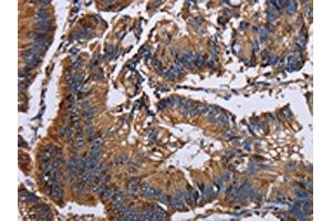 The image on the left is immunohistochemistry of paraffin-embedded Human colon cancer tissue using ABIN7130044(KRT31 Antibody) at dilution 1/30, on the right is treated with fusion protein.