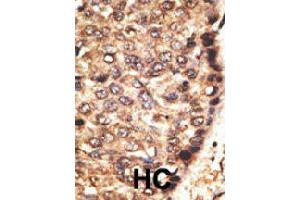 Formalin-fixed and paraffin-embedded human hepatocellular carcinoma tissue reacted with MMP24 polyclonal antibody  , which was peroxidase-conjugated to the secondary antibody, followed by AEC staining. (MMP24 antibody  (Internal Region))