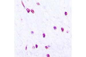 Immunohistochemical analysis of CDC25C (pS216) staining in human lung cancer formalin fixed paraffin embedded tissue section.