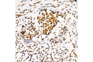 Immunohistochemistry of paraffin-embedded human cervix cancer using Phospho-POLR2A CTD-S2 Rabbit mAb  at dilution of 1:200 (40x lens).