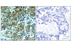 Immunohistochemical analysis of paraffin-embedded human breast carcinoma tissue, using Cortactin (Ab-466) antibody (E021264). (Cortactin antibody)