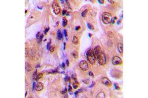 Immunohistochemical analysis of MKK1 (pT292) staining in human breast cancer formalin fixed paraffin embedded tissue section. (MEK1 antibody  (pSer292))