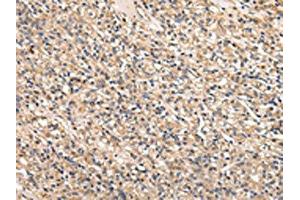 The image on the left is immunohistochemistry of paraffin-embedded Human prostate cancer tissue using ABIN7128011(SERPINA7 Antibody) at dilution 1/25, on the right is treated with fusion protein. (SERPINA7 antibody)