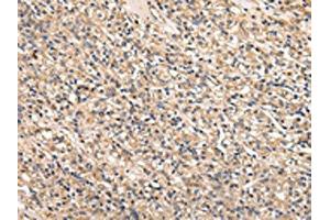 The image on the left is immunohistochemistry of paraffin-embedded Human prostate cancer tissue using ABIN7128011(SERPINA7 Antibody) at dilution 1/25, on the right is treated with fusion protein. (SERPINA7 antibody)