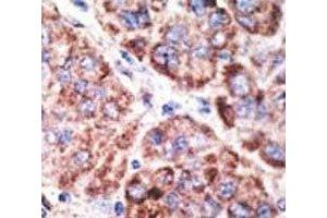 IHC analysis of FFPE human hepatocarcinoma tissue stained with the TLR6 antibody (TLR6 antibody  (AA 1-30))