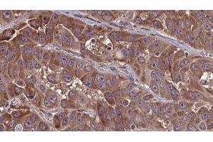 ABIN6277662 at 1/100 staining Human liver cancer tissue by IHC-P. (LSP1 antibody  (C-Term))