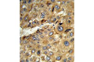 Formalin-fixed and paraffin-embedded human hepatocarcinoma reacted with TAT Antibody (Center), which was peroxidase-conjugated to the secondary antibody, followed by DAB staining. (Tat (AA 279-306) antibody)