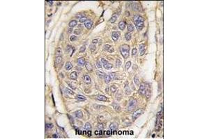 Formalin-fixed and paraffin-embedded human lung carcinoma tissue reacted with B2M antibody (C-term) (ABIN389259 and ABIN2839397) , which was peroxidase-conjugated to the secondary antibody, followed by DAB staining. (beta-2 Microglobulin antibody  (C-Term))