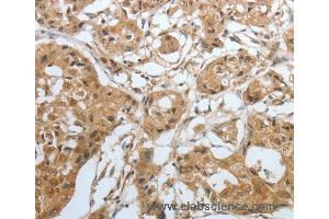 Immunohistochemistry of Human lung cancer using AMPH Polyclonal Antibody at dilution of 1:30 (Amphiphysin antibody)