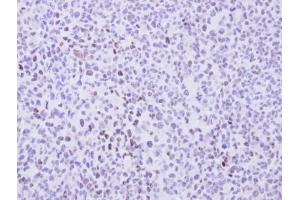 IHC-P Image Immunohistochemical analysis of paraffin-embedded H1299 Xenograft, using cyclin T2, antibody at 1:100 dilution. (Cyclin T2 antibody  (C-Term))