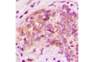 Immunohistochemical analysis of BRP44L staining in human breast cancer formalin fixed paraffin embedded tissue section. (BRP44L antibody  (N-Term))