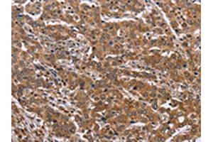 The image on the left is immunohistochemistry of paraffin-embedded Human liver cancer tissue using ABIN7129424(FAAH2 Antibody) at dilution 1/30, on the right is treated with fusion protein.