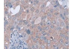 Detection of D2HGDH in Human Breast cancer Tissue using Polyclonal Antibody to D2-Hydroxyglutarate Dehydrogenase (D2HGDH) (D2HGDH antibody  (AA 56-232))