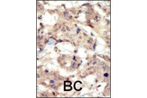 Formalin-fixed and paraffin-embedded human cancer tissue reacted with the primary antibody, which was peroxidase-conjugated to the secondary antibody, followed by DAB staining. (EPH Receptor B6 antibody  (N-Term))