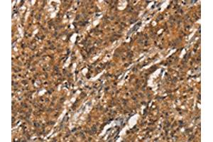 The image on the left is immunohistochemistry of paraffin-embedded Human gastric cancer tissue using ABIN7189855(APOC4 Antibody) at dilution 1/20, on the right is treated with synthetic peptide. (APOC4 antibody)