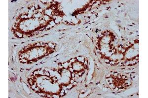 IHC image of ABIN7173536 diluted at 1:400 and staining in paraffin-embedded human breast cancer performed on a Leica BondTM system. (TSEN15 antibody  (AA 1-171))