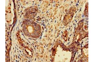 Immunohistochemistry of paraffin-embedded human prostate cancer using ABIN7153175 at dilution of 1:100 (FZD1 antibody  (AA 73-322))