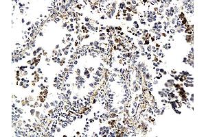 Formalin-fixed and paraffin embedded human lung cancer labeled with Anti-CK7 (Human) Polyclonal Antibody, Unconjugated (ABIN732023) followed by conjugation to the secondary antibody and DAB staining (Cytokeratin 7 antibody  (AA 251-350))