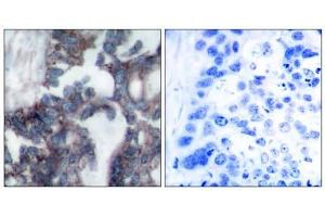 Immunohistochemical analysis of paraffin-embedded human breast carcinoma tissue, using p70 S6 Kinase (phospho-Ser424) antibody (E011284). (RPS6KB1 antibody)